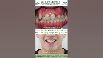 Hình ảnh niềng răng trước và sau tại Nha khoa AVA - Răng mọc chen chúc
