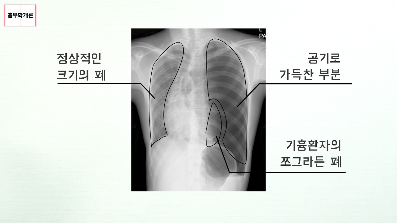 기흉? 누구나 걸릴 수 있다?? - YouTube