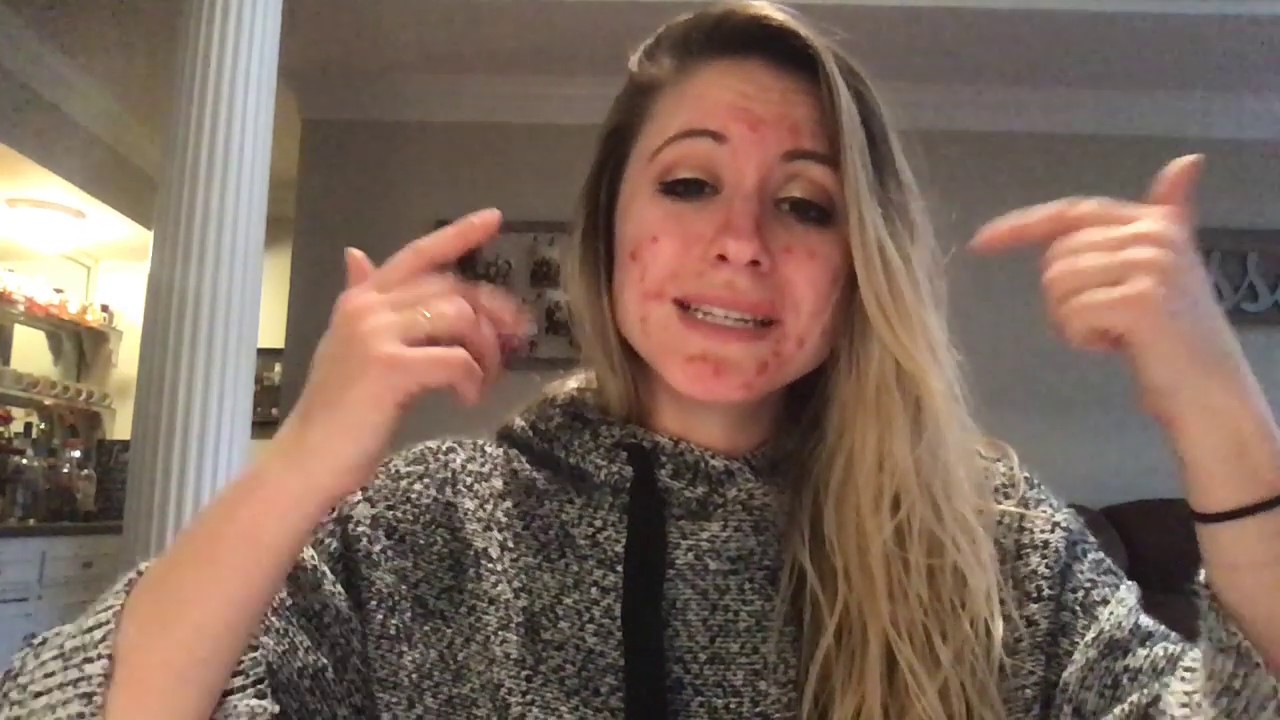 TRETINOIN PURGE! MY Experience!