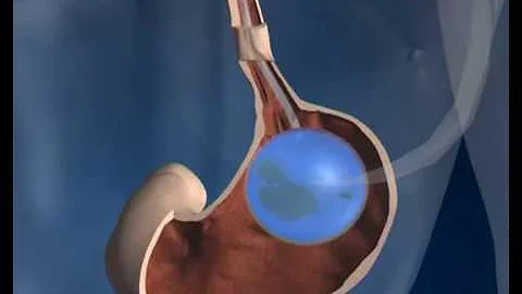 Gastric Balloon Surgery - how it works | Phoenix Health