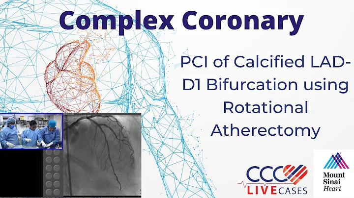 PCI of Calcified LAD-D1 Bifurcation using Rotational Atherectomy - CCC Live Cases Aug 2016