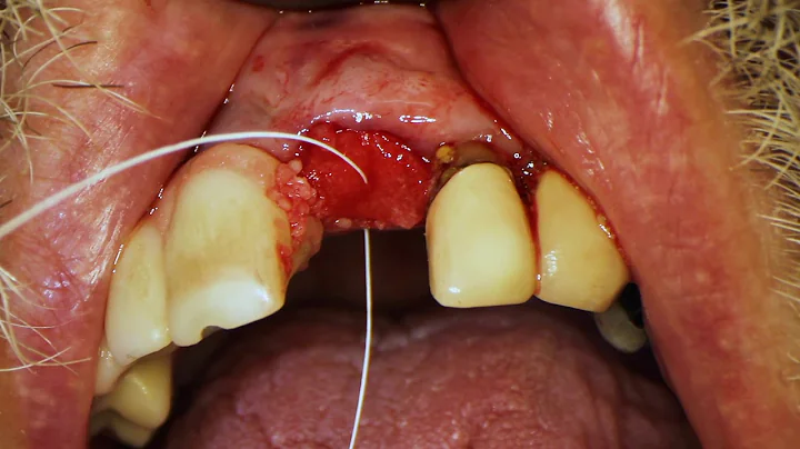 Can I eat ice cream after bone graft? (2023)