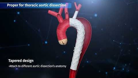 Castor Branched Aortic Stent Graft System