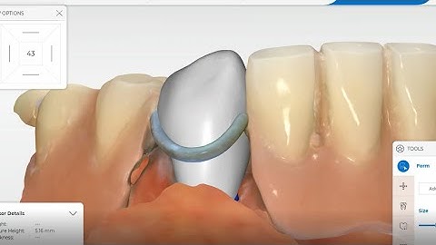 Cerec Primescan - Crown under partial denture
