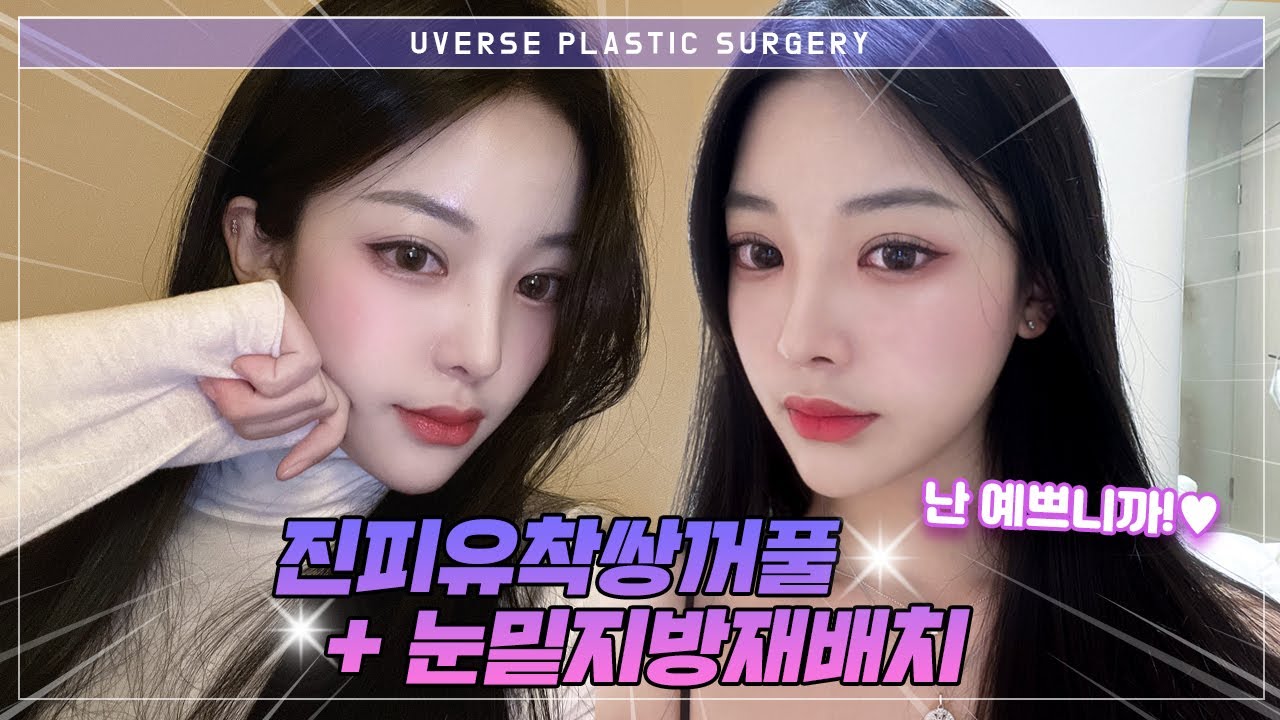 [Вивэрс гоо сайхны мэс заслын эмнэлэг] [Вивэрс гоо сайхны мэс засал] Арьс наалдуулах (3-р үеийн байгалийн наалт) + Нүдний доорх өөхийг дахин байршуулах тойм