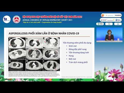 Video: Cách nhận biết các triệu chứng bệnh Aspergillosis: 12 bước (có hình ảnh)