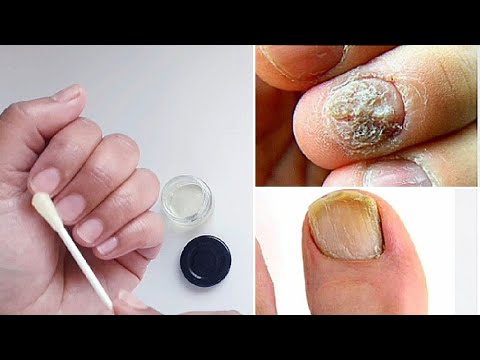 Video: Paano Mag-apply ng Neosporin: 11 Mga Hakbang (na may Mga Larawan)