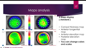 How to read MS39 AS OCT Corneal Topography. Dr.Yasser RIFAY  / ENGLISH ( Phoenix 3.7)