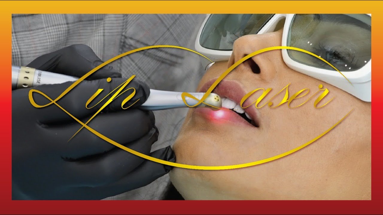 Lip Laser Depigmentation YouTube Lip Laser Depigmentation YouTube