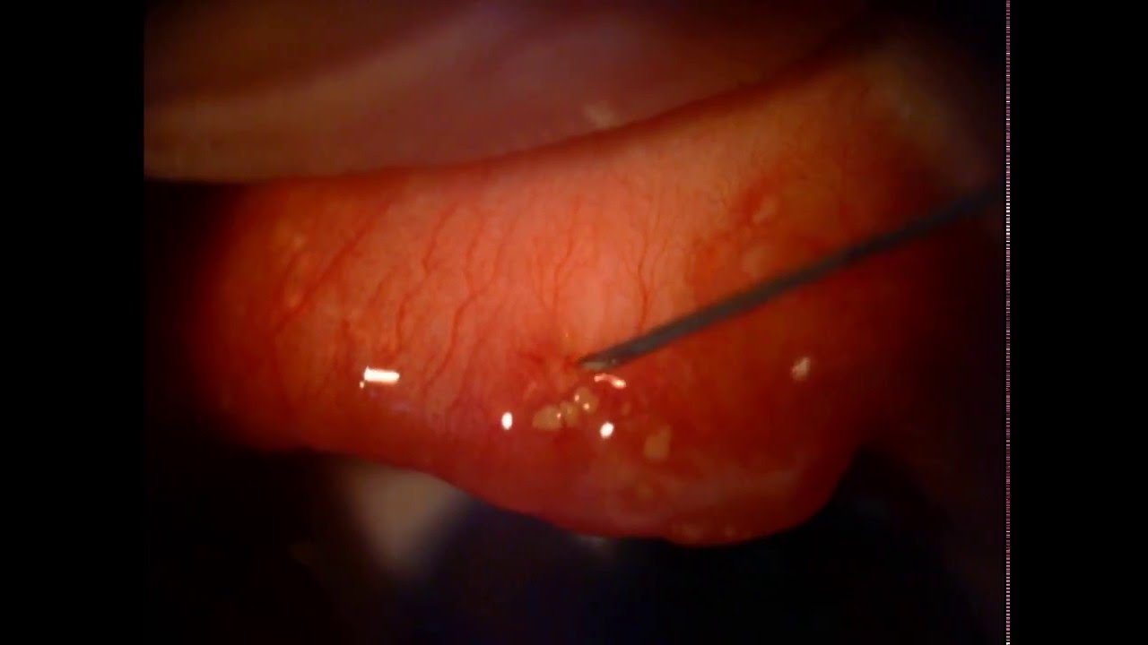 Conjunctival lithiasis (concretion) 眼結膜結石 20160316 新眼光眼科診所 YouTube