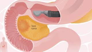 Eus Guided Injection For Treatment Of Pancreatic Cancer With Nanopac