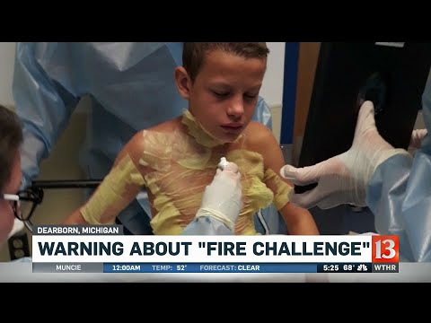 Mother sends warning about "Fire Challenge" after her son is badly burned