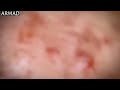 👉 "Satisfying Acne Treatment That Will Blow Your Mind 🤯"