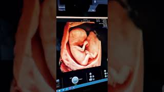 12-WEEK 3D PREGNANCY!