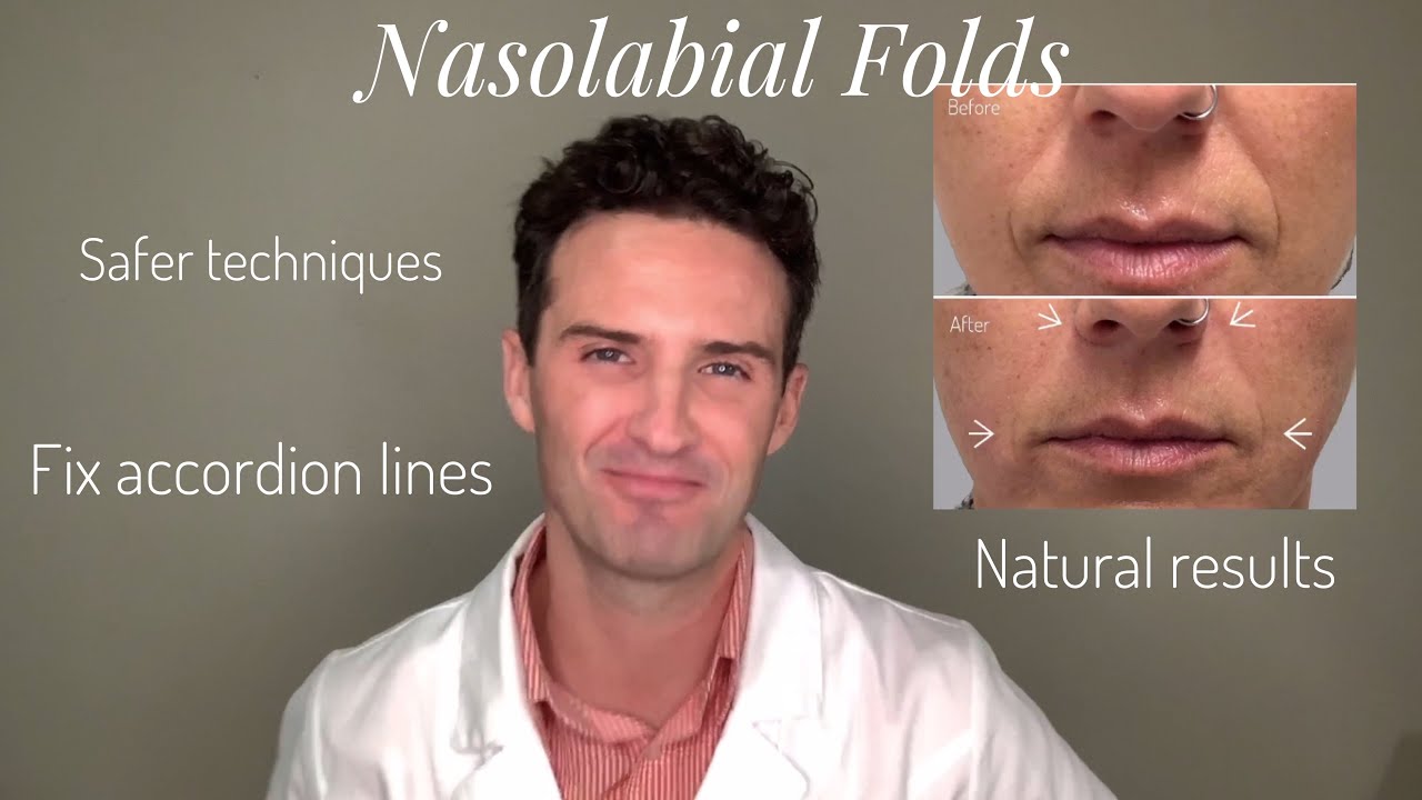 nasolabial folds