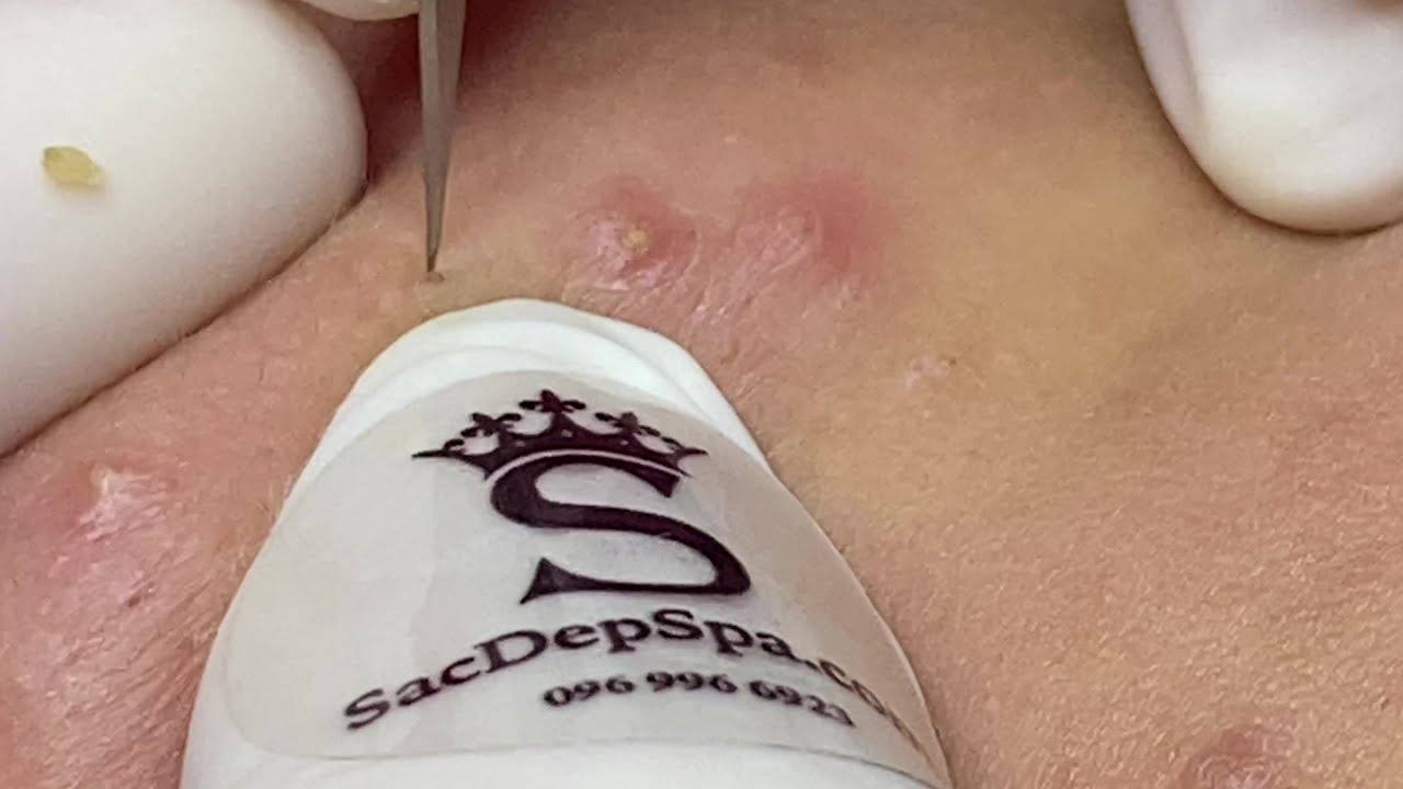 Blackheads & Whiteheads Treatment | Trị Mụn Đầu Đen Và Mụn Ẩn Trên Da - SacDepSpa#171