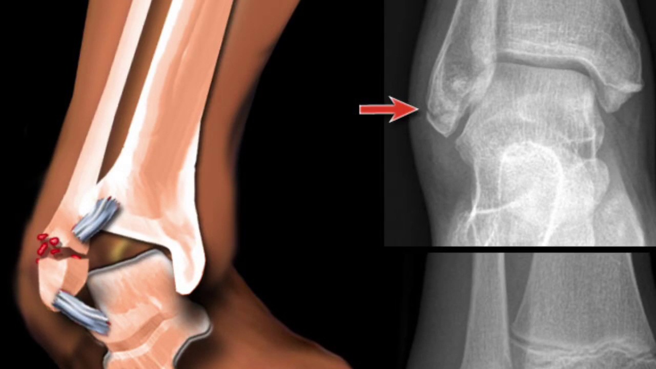 Пластина при переломе большеберцовой кости. Перелом локтевой кости со смещением. После операции закрытый перелом со смещением. Накостный остеосинтез лодыжки. После операции закрытый перелом со смещением.