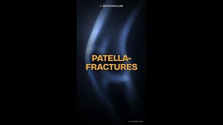 Patella Fractures Masterclass: Tension Band Fixation &amp; Extensor Mechanism