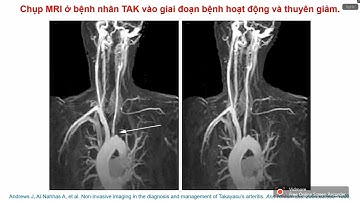 NHỮNG CẬP NHẬT MỚI TRONG CHIẾN LƯỢC ĐIỀU TRỊ BỆNH LÝ VIÊM ĐỘNG MẠCH TAKAYASU