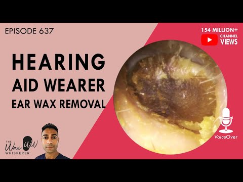 637 - Hearing Aid Wearer Ear Wax Removal