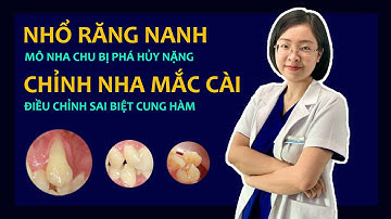 #Case 23: Nhổ Răng Nanh | Bí Mật Của Chiếc "Răng Khểnh" | Chỉnh Nha Mắc Cài Vinalign