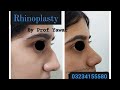 rhinoplasty in lahore.nose job pakistan.best plastic surgeon lahore.