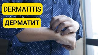 DERMATITIS | ДЕРМАТИТ