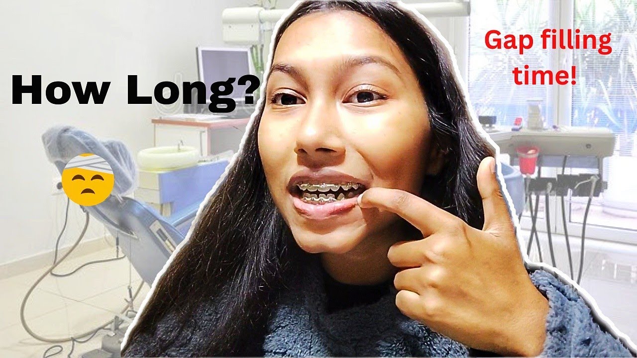 Удаление зуба с брекетами: закроется ли когда-нибудь щель между зубами?