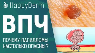 ВПЧ! ПРИЧИНЫ И ЛЕЧЕНИЕ. НАСКОЛЬКО ОПАСЕН ВИРУС ПАПИЛЛОМЫ ЧЕЛОВЕКА И КАК УДАЛИТЬ ПАПИЛЛОМЫ В МИНСКЕ