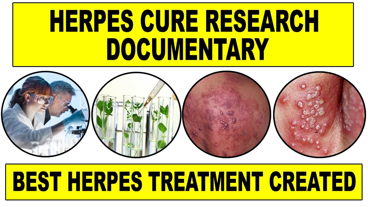 Herpes Cure Research Documentary - How Was The Best Herpes Treatment Created - YouTube