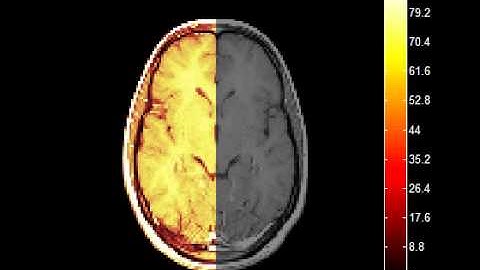 brain mri overlap generated by immovie2