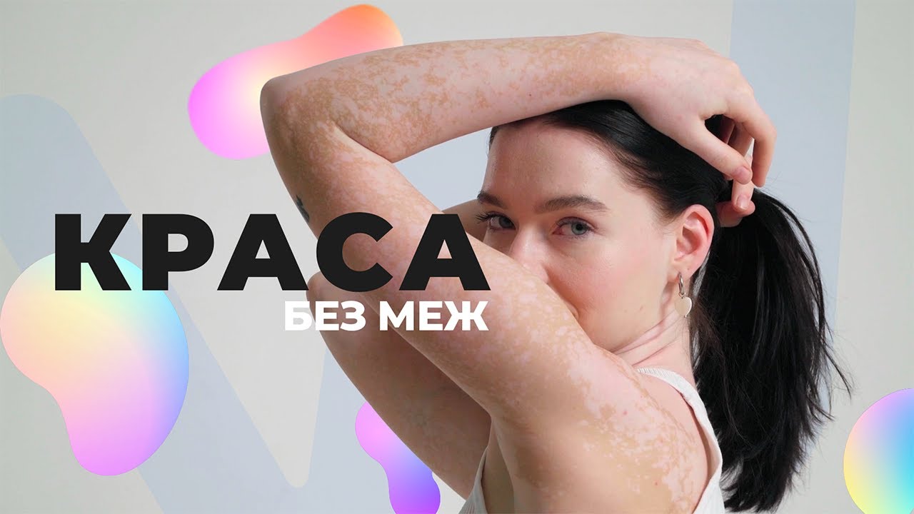 КРАСА БЕЗ МЕЖ | Життя з вітиліго - YouTube
