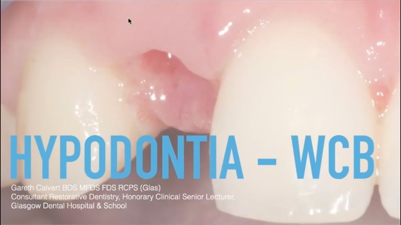 Restorative aspects of Hypodontia