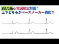 心電図:暗記から卒業149話 Blocked PAC と洞房ブロックの鑑別