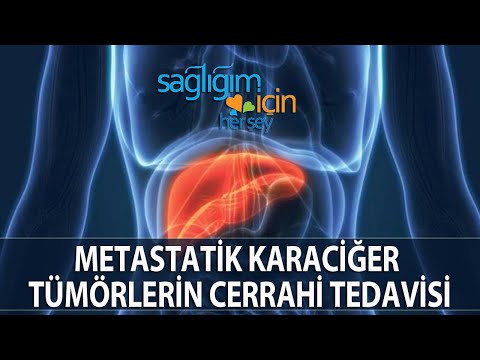 Metastatik Karaciğer Tümörlerin Cerrahi Tedavisi