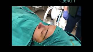 Rhinoplasty - Burun Estetiği