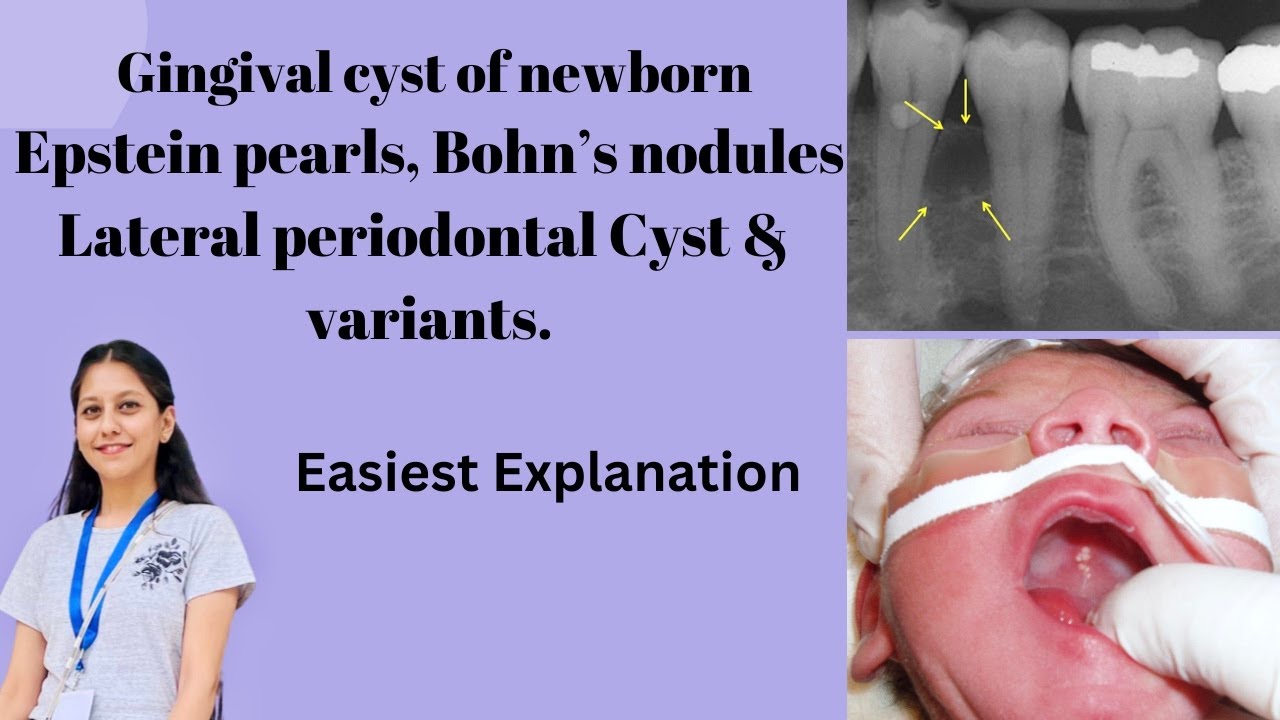 oral-pathology-bds-gingival-cyst-of-newborn-epstein-pearls-bohn-s