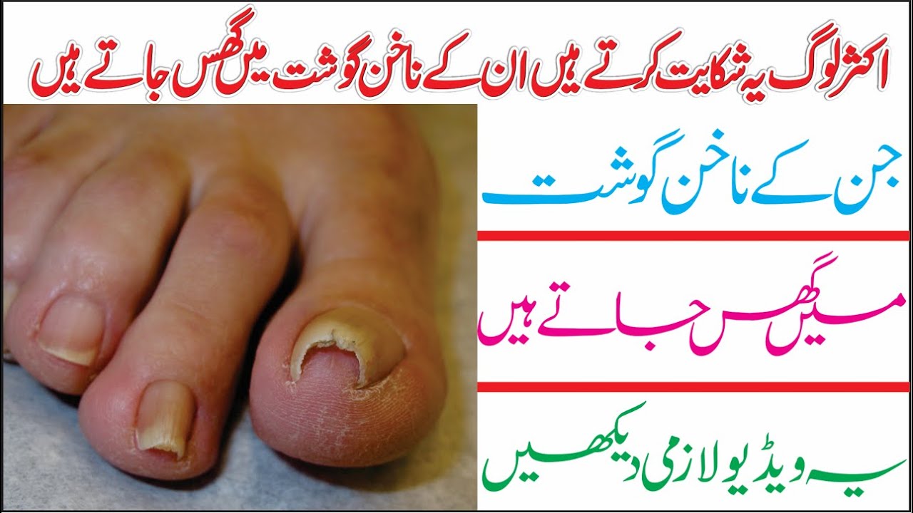 Nails Treatment Agr Ap k Nakhun Gosht main Gus jate hai to kya kren