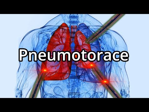 Video: Pneumotorace Del Polmone