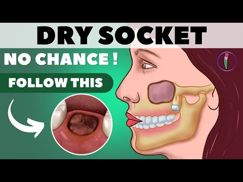 Video: 3 snadné způsoby, jak jíst po extrakci zubu