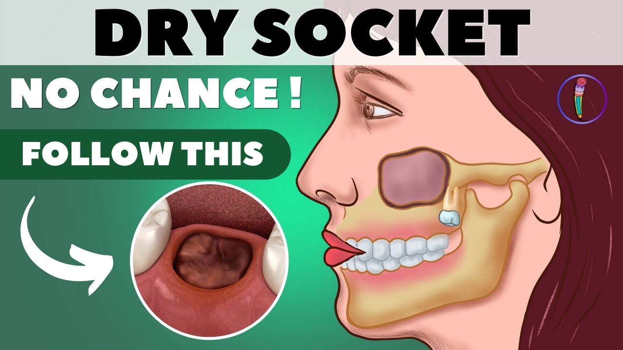 Tooth Extraction Aftercare I Wisdom Tooth Extraction - Tips For Faster Healing \U0026 Prevent Dry Socket