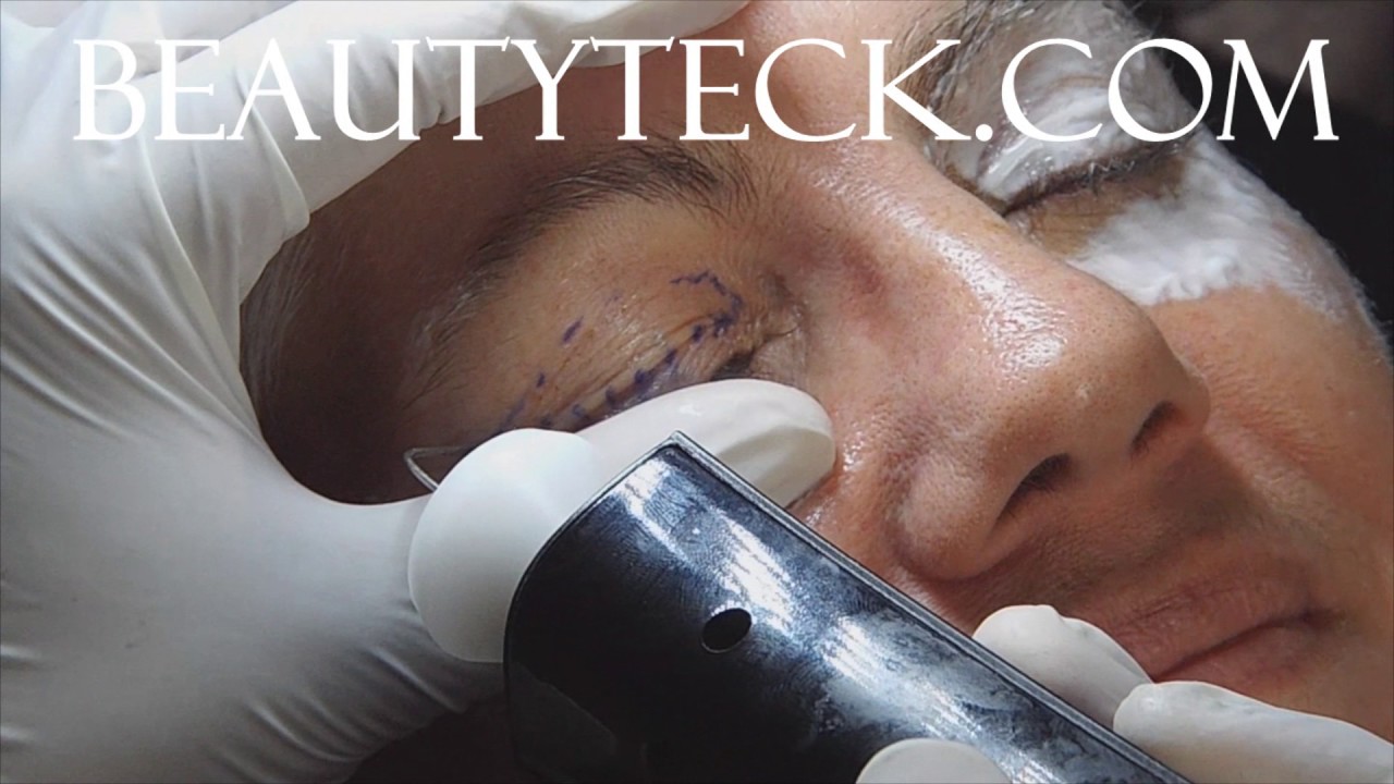 Upper eyelid tightening low intensity treatment example. YouTube