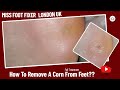 How To Remove a Corn From Feet *** Foot Corn Full Treatment By Miss Foot Fixer***