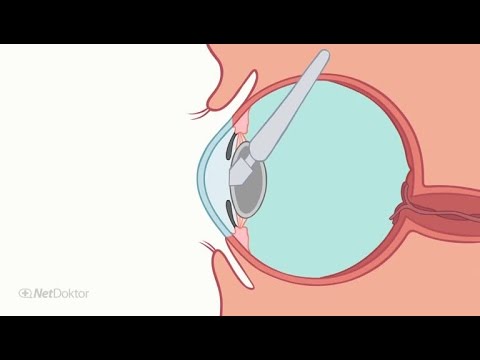 Kopfschmerzen: Unterschiedliche Formen - NetDoktor.de