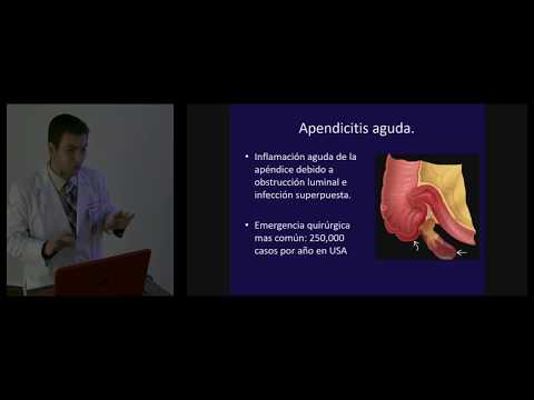Vídeo: Infiltrado Apendicular - Causas, Sintomas, Diagnóstico E Tratamento De Infiltrado Apendicular