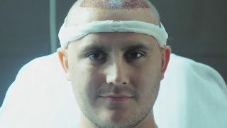 トルコの植毛ビジネス　手術を受けた英男性の体験を追う