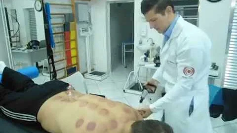 Como tirar marcas de ventosa?