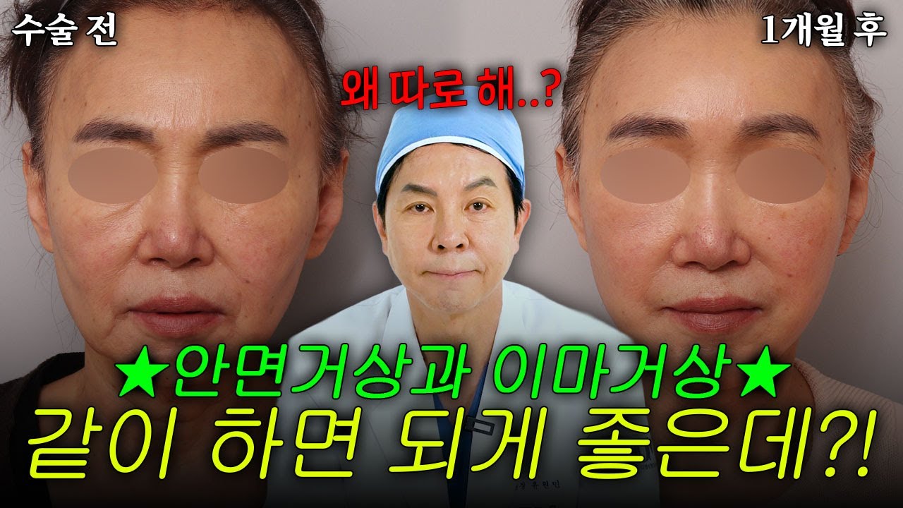 안면거상•이마거상 같이 하면 두배 좋다? 아니다? #안면거상