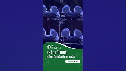 Tháo túi ngực không rõ nguồn gốc sau hơn 10 năm. #thaotuinguc