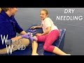 Dry Needling | Tough Gymnast | Stick a Needle in my Knees Please